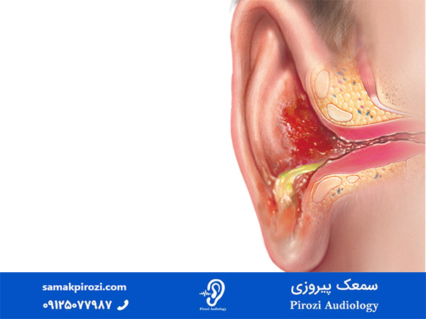 عفونت های گوش خارجی و گوش درد