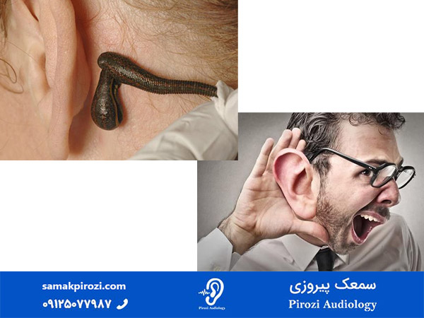 فواید زالو درمانی در بیماری های گوش
